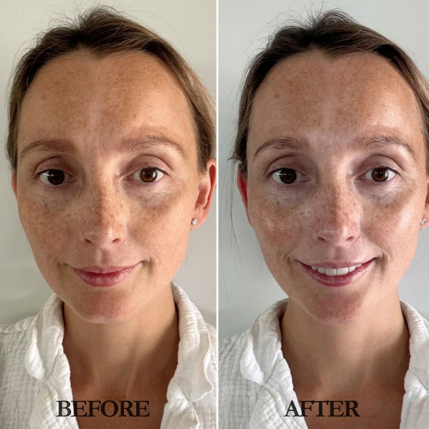 3D Lifting V-Line Mask